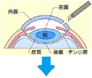 切開