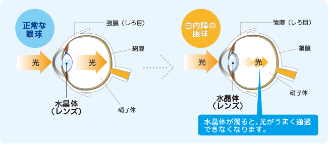 白内障図解