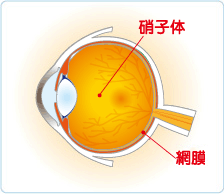 緑内障図解