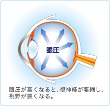 緑内障図解